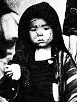 child scorched by Hiroshima blast