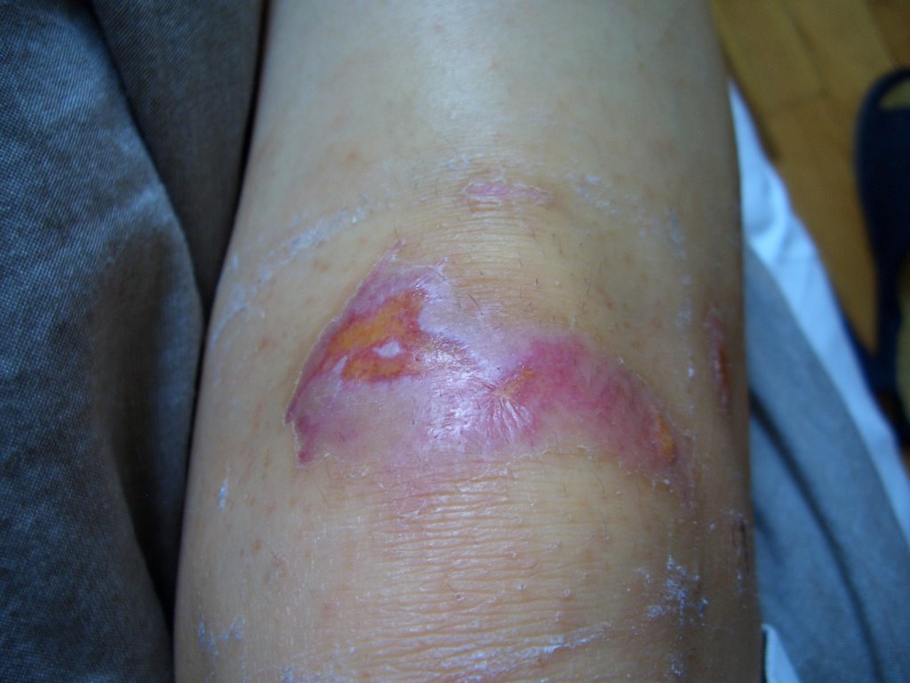 Macrobiotic In Harlem 膝の傷