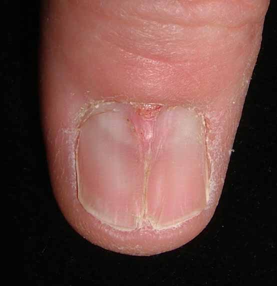What Is Pterygium - Health - NAILS Magazine