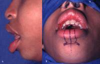 Vertical Incision