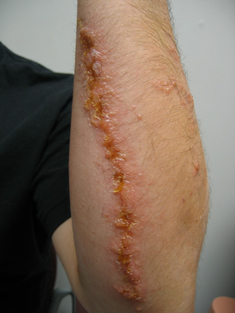 Harbor Hospital Residents Pow Young Male With Vesicular Forearm Rash