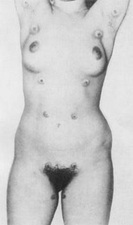 extranumerary nipples #11