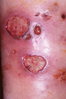 Estreptococo pyogenes por celulitis