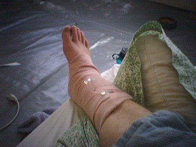 ankle in cast