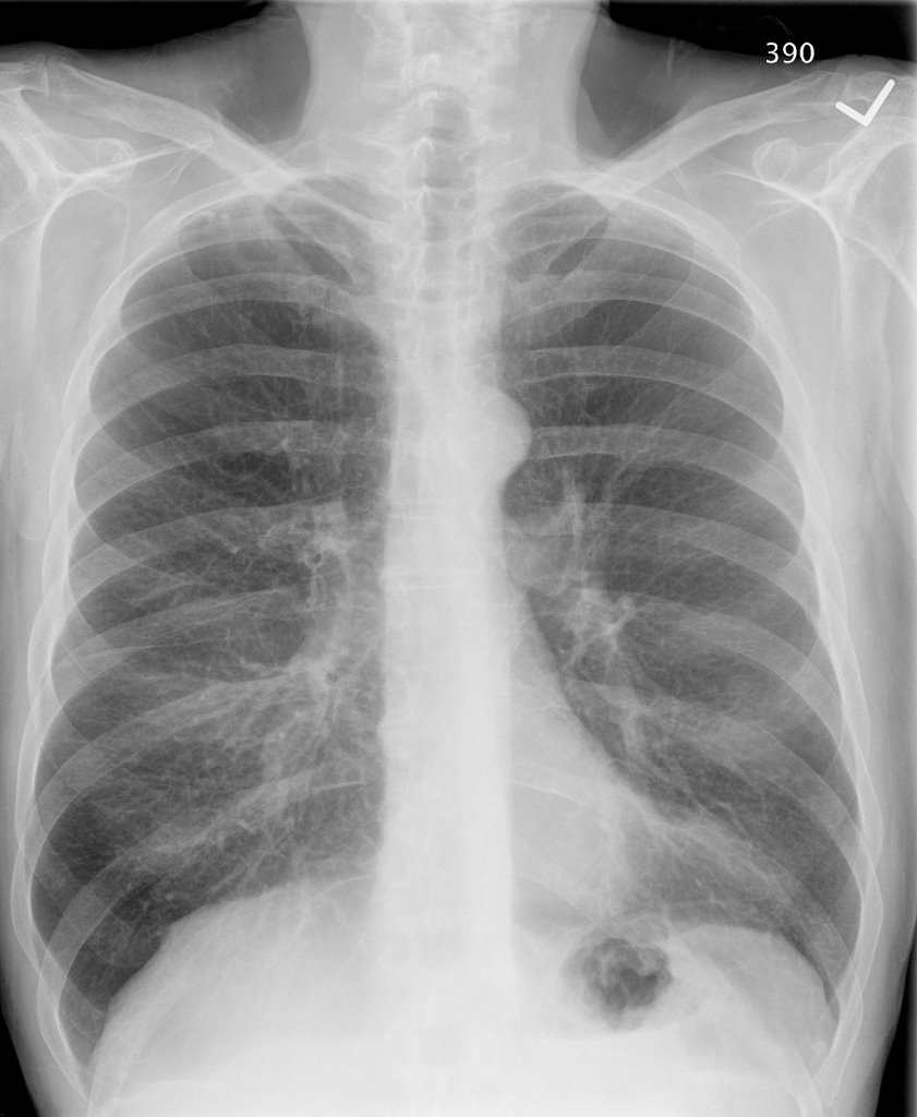 Pulmonary Roundtable Abnormal CT Scan
