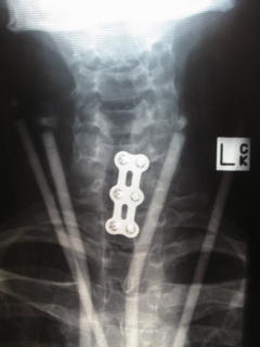 X-Ray of my neck from the front - the 4 lighter bars are from the brace