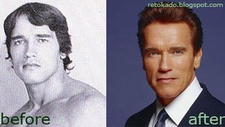Arnold Swarzenager Picture Plastic Surgery