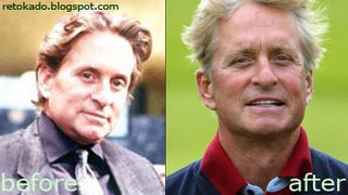 Michael Douglas' Before and After Plastic Surgery Picture