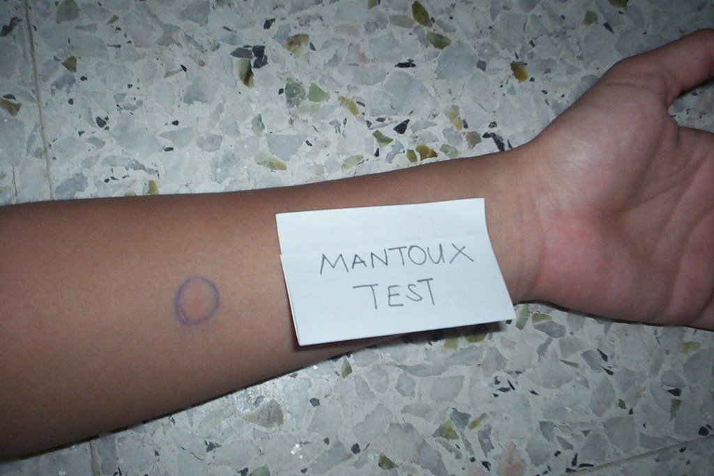 Between The Lines MANTOUX Test