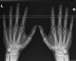 Amal Graafstr's RFID implanted hands
