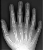 X-ray of six-fingered hand