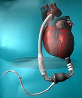 HeartMateII - A continuous flow cardiac assist device.