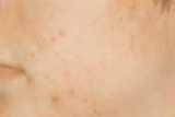 Acne pimple breakouts image
