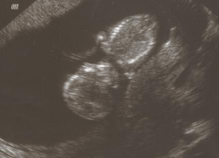 Seeley Family: Second Ultrasound - 11 weeks