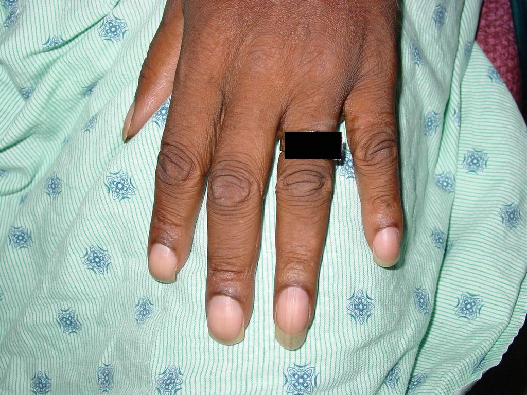 CasesBlog - Medical and Health Blog: Finger Clubbing due to Lung Cancer