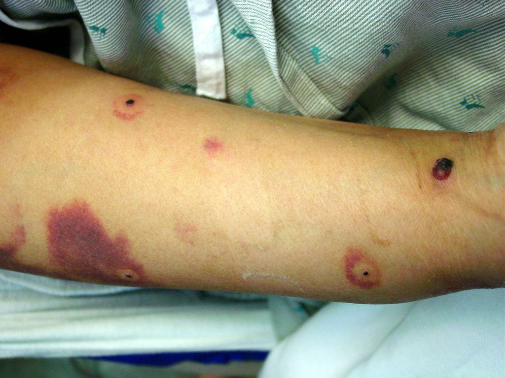 Warfarin-Induced Skin Necrosis - Hospital Physician