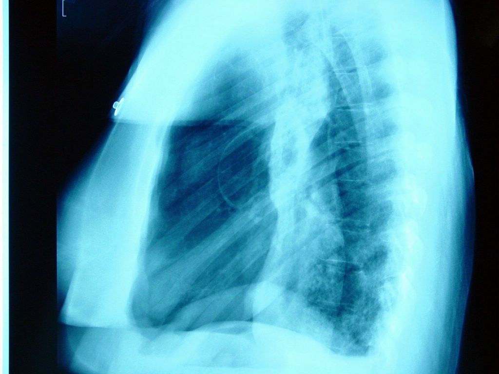 X-ray of a collapsed lung