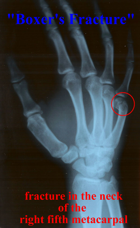 Трещина в кисти. Перелом пястной кости рентген. Перелом пястной кости 4 пальца. Перелом 2 пястной кости.