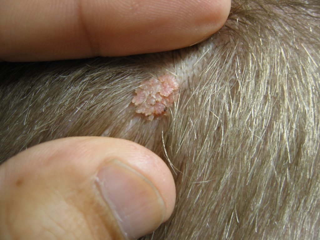 Harbor Hospital Residents Pow Warty Growth On The Scalp