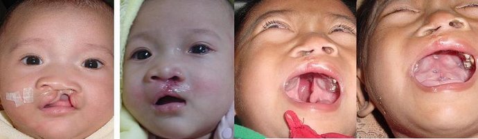 HELPING CHILDREN WITH CLEFT LIP and PALATE in INDONESIA