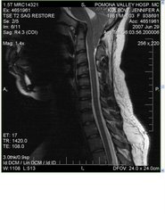 This was my neck before surgery