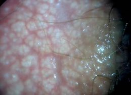 Papiloma humano labios genitales
